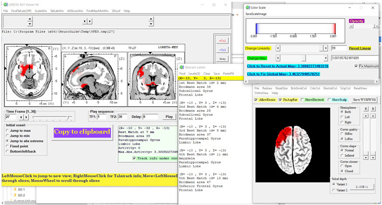 Figure 7 - Baseline eyes-closed z-score LORETA analysis for 27 Hz
